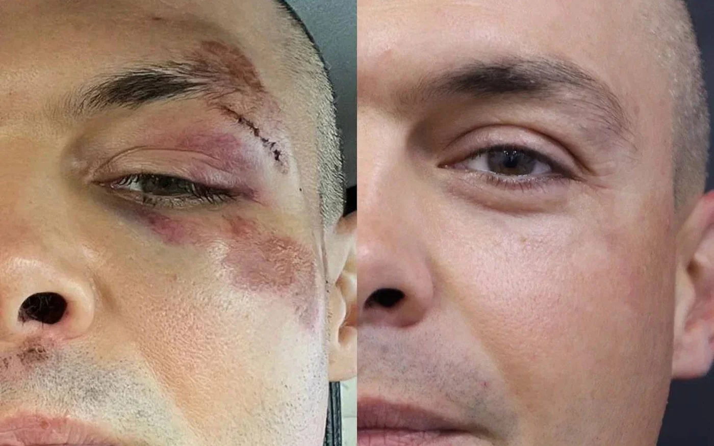 Рубец после травмы: до и после, клиника MedDESA в Сочи