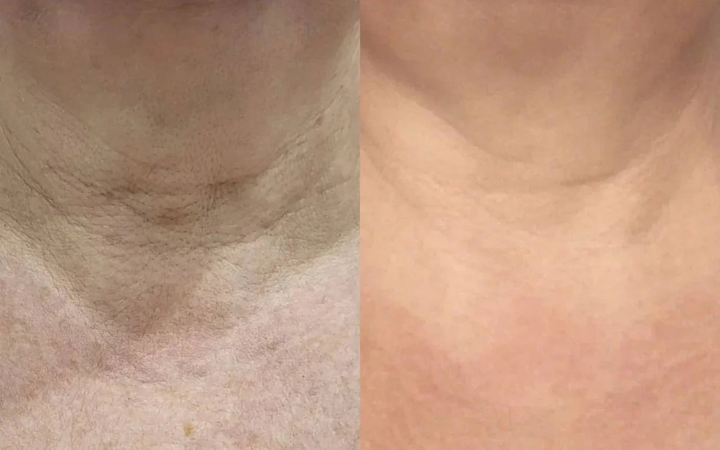 Шея и декольте: до и после, клиника MedDESA в Сочи